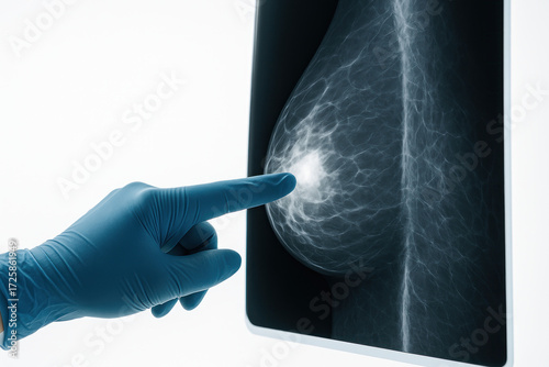 Breast cancer early detection medical concept mammogram image showing radiologist pointing to suspicious mass encouraging screening and timely diagnosis