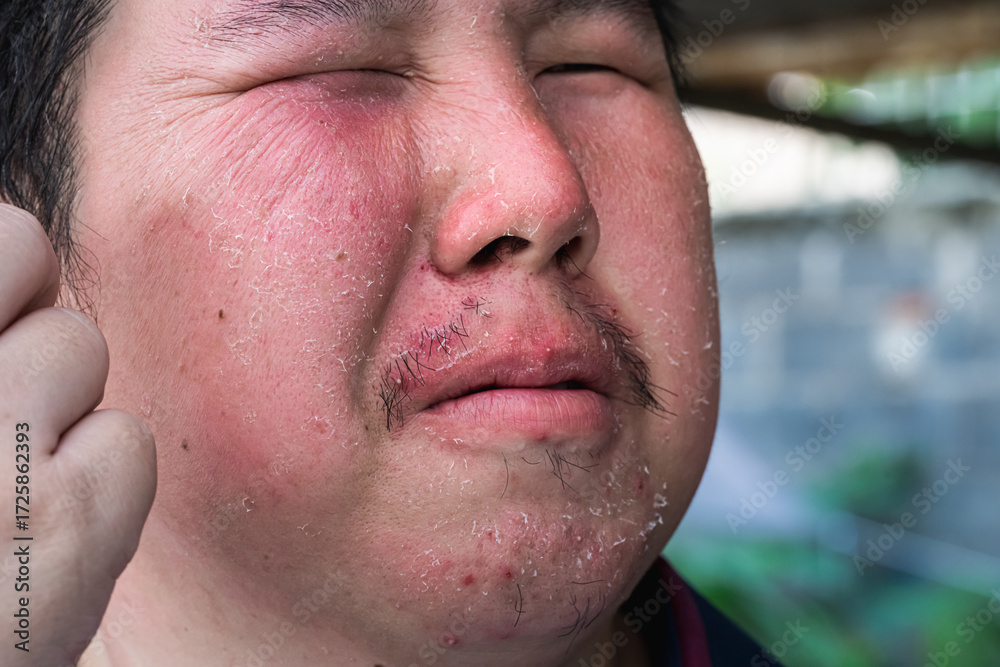 Naklejka premium A close-up of a person's face suffering from a severe skin condition, with red, flaky patches. The image is a medical or conceptual photo of a health issue.
