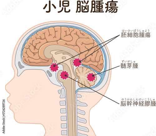 小児 こどもの脳腫瘍　Childhood brain tumors