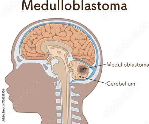 小児 こどもの脳腫瘍　Childhood brain tumors
