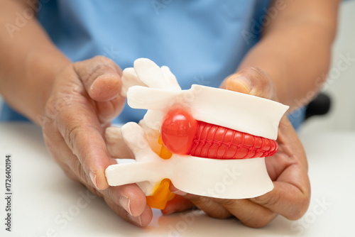 Asian doctor holding spinal nerve and bone model, Lumbar spine displaced herniated disc fragment for treatment medical in the orthopedic department.