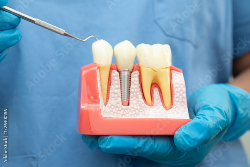 Dental implant, artificial tooth roots into jaw, root canal of dental treatment, gum disease, teeth model for dentist studying about dentistry.