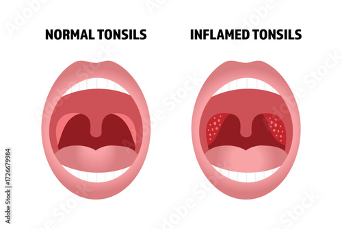 Tonsils anatomical illustration, comparison between healthy and inflamed palatine tonsils.