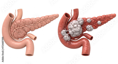 Pancreatitis & Cancer vs Normal Pancreas Anatomy