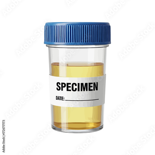 A clear plastic specimen cup with a blue lid, filled with a yellow liquid, labeled for medical testing.