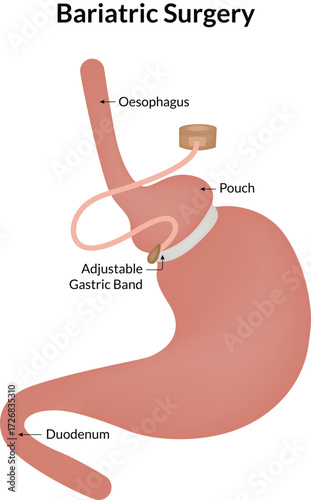 Bariatric Surgery Procedures Gastric Balloon Sleeve Band and Bypass Vector Illustration