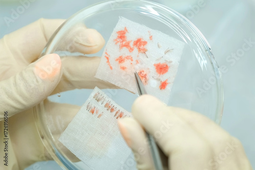 Surgeon nurse hands putting changing hair grafts using tweezers preparing it to hair transplantation in clinic. Problem of baldness, treatment of alopecia by hair transplant surgery in hospital.