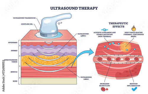 Ultrasound therapy diagram shows a transducer applying sound waves to tissue layers, illustrating deep tissue effects and therapeutic benefits. Outline diagram