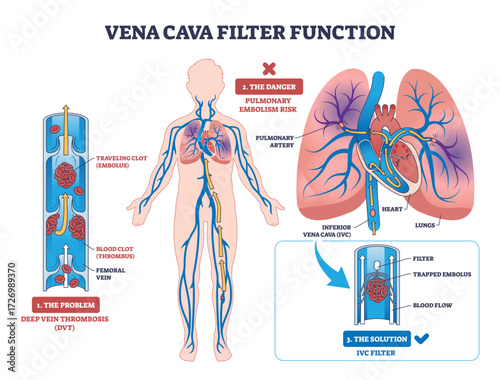 Vena cava filter diagram shows blood clot prevention in veins, highlighting filter, blood flow, and clot. Outline diagram