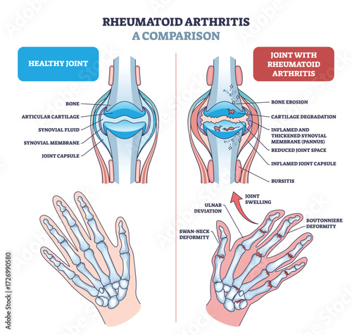 Rheumatoid arthritis diagram shows a comparison between healthy and affected joints, highlighting bone erosion, cartilage loss, and joint swelling. Outline diagram