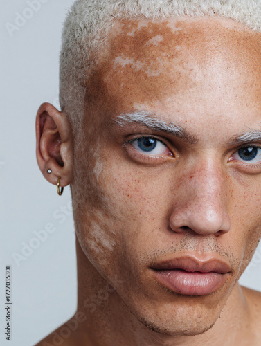 Young man with vitiligo, brown skin with white patches on face, blue eyes and white eyebrows. Albino. Diversity concept of unique beauty