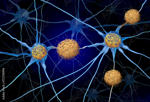 Fotografie Tau Tangles And Amyloid Beta concept as abnormal clusters of protein fragments t