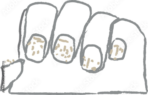 Broken fingernail reveals damaged nail bed and skin infection concern