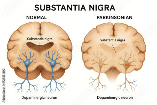 Comparative illustration of a normal substantia nigra and a substantia nigra affected by Parkinson's disease, depicting dopaminergic neurons.