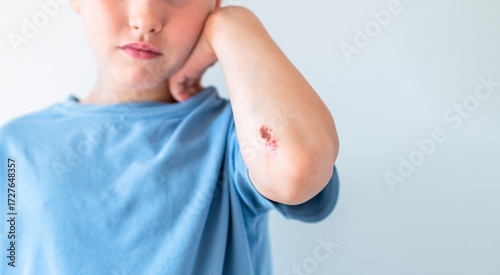 Quadro em tela Child showing a painful scraped elbow with an open wound on the skin, a common m