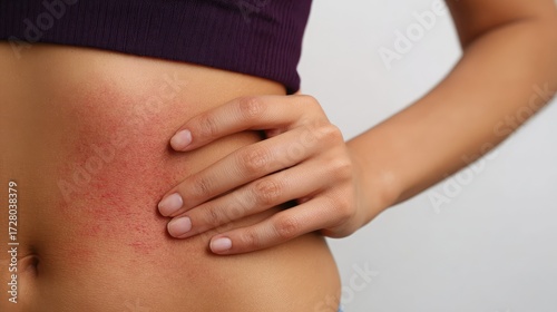 Wallpaper Mural Close-up of a woman's torso showing irritated skin with red patches while she gently holds her side, highlighting skin sensitivity and health issues in a clinical context. Torontodigital.ca