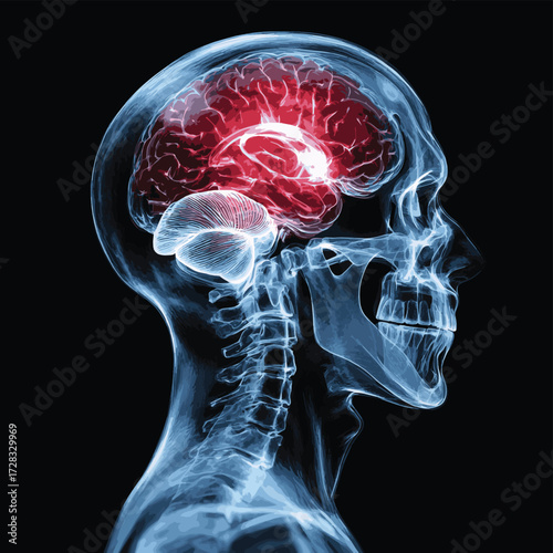Side view X-ray image of a human skull showing a highlighted red area in the brain, indicating a stroke or brain injury. , vector style simple color