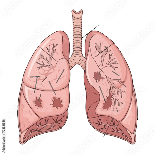 Human lungs showing damage and lesions, indicative diseases like asbestosis or lung cancer