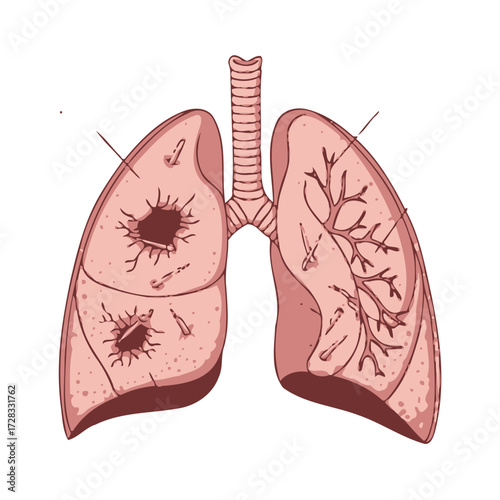 Human lungs showing damage from asbestos fibers, with labels pointing to affected areas