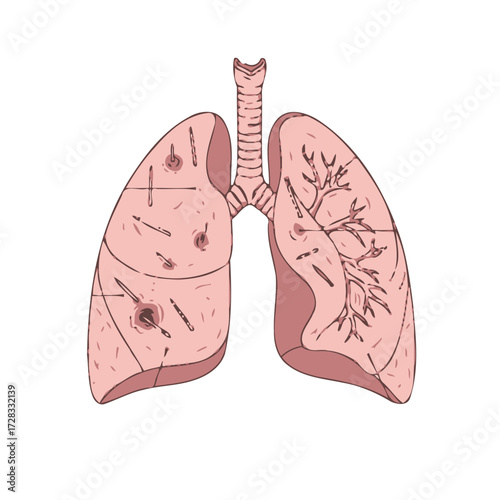 Human lungs showing damage from inhaled particles, possibly representing lung disease or occupational hazard