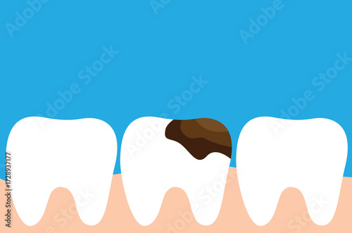 Row of Teeth one Tooth with Cavity Flat Style. Health care and medicine concept vector art, visiting dentist