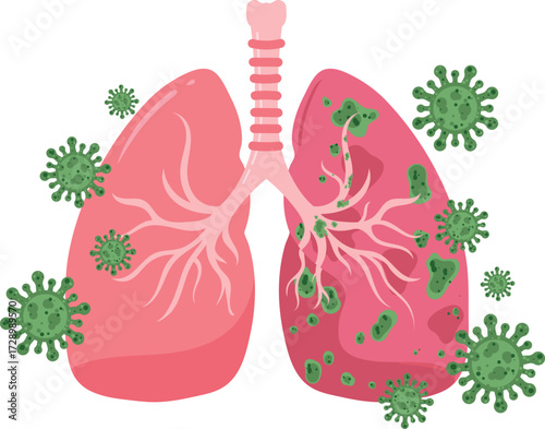Lungs Infected with Virus Medical Illustration