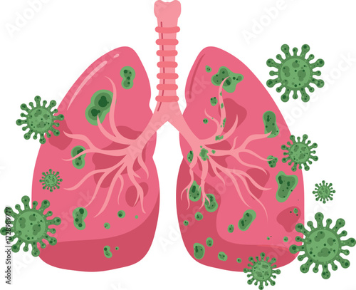 Lungs infected with viruses, medical illustration