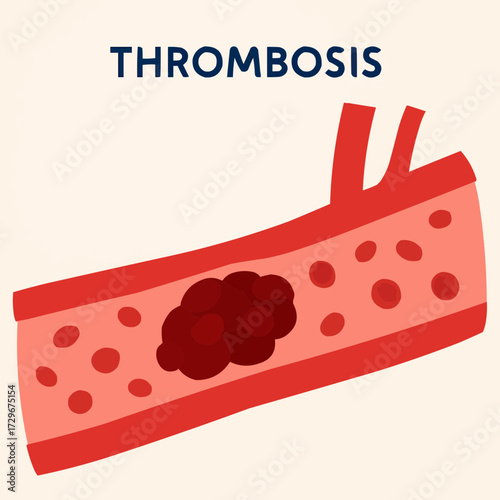 A flat vector illustration of a thrombosis clot in a simplified circulatory system, designed for healthcare visuals
