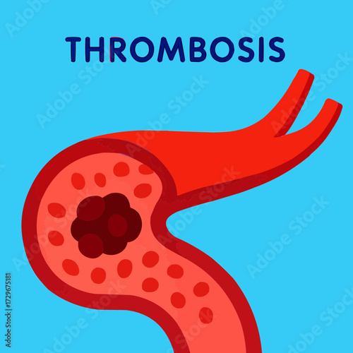 A flat vector illustration of a thrombosis clot in a stylized artery, with a focus on vibrant colors and flat design