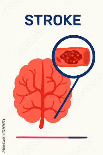A flat vector illustration of a thrombosis clot in a brain vessel, with a focus on stroke awareness