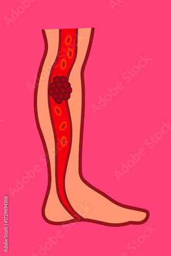 A flat vector illustration of a thrombosis clot in a leg artery, with a focus on deep vein thrombosis prevention