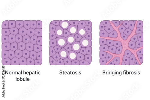 Liver Tissue Progression: Normal to Steatosis to Fibrosis