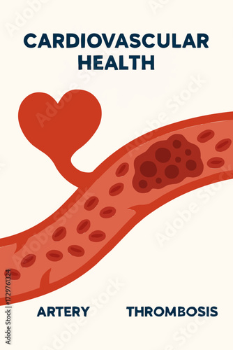 A flat vector illustration of a thrombosis clot in a stylized artery, with a focus on cardiovascular health