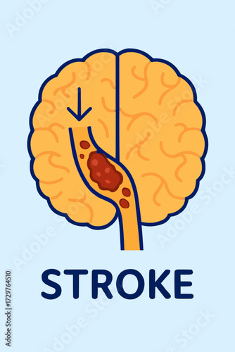 A flat vector illustration of a thrombosis clot in a brain vessel, with a focus on stroke education