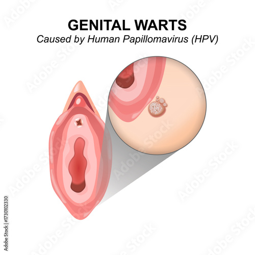 Genital Warts (HPV Infection) flashcard
