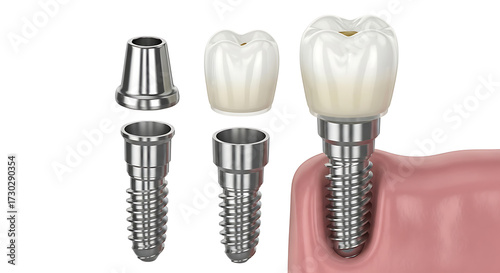 Dental implant components and installed tooth on white background