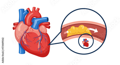 Understanding atherosclerosis and its impact on the human heart and blood vessels.