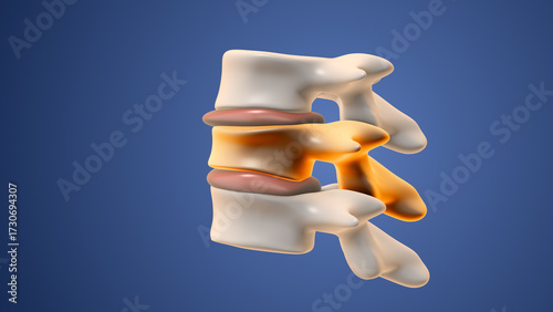 Medical Visualization of Kyphoplasty and Vertebroplasty Treatment