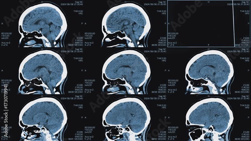 Magnetic resonance images of the head, MRI of the brain, side and top viev of a patient with multiple vascular infarctions,1 image and 3x3 grid, monochrome animation Seamless Loop