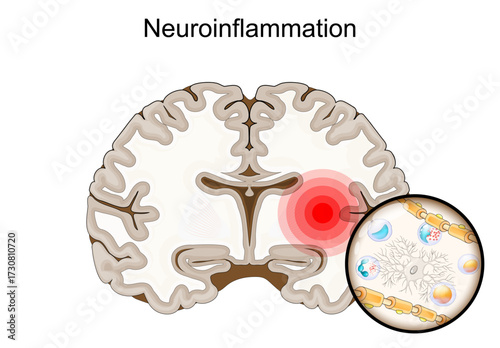 Neuroinflammation. Cross section of human brain with inflammation