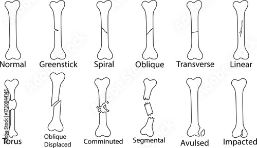 Types of Bone Fractures Illustration – Medical Diagram and Anatomy Reference..eps