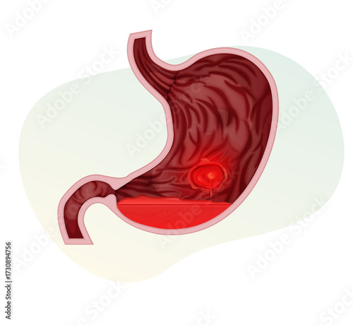 Peptic Ulcer - Stomach Ache - Illustration
