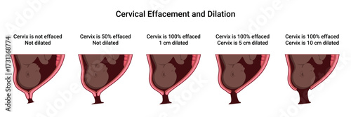 Cervical Effacement and Dilation. Various processes in the Uterus during Childbirth. Thinning and shortening of the Cervix. Detailed medical vector illustration. The fetus is in the uterus
