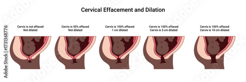 Cervical Effacement and Dilation. Various processes in the Uterus during Childbirth. Thinning and shortening of the Cervix. Detailed medical vector illustration. The fetus is in the uterus
