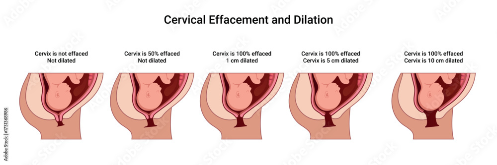 Obraz premium Cervical Effacement and Dilation. Various processes in the Uterus during Childbirth. Thinning and shortening of the Cervix. Detailed medical vector illustration. The fetus is in the uterus 