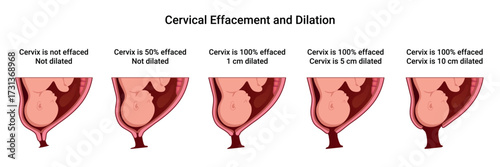 Cervical Effacement and Dilation. Various processes in the Uterus during Childbirth. Thinning and shortening of the Cervix. Detailed medical vector illustration. The fetus is in the uterus
