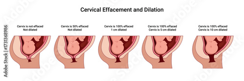 Cervical Effacement and Dilation. Various processes in the Uterus during Childbirth. Thinning and shortening of the Cervix. Detailed medical vector illustration. The fetus is in the uterus
