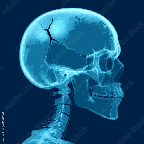 Head injury with visible crack on skull - Medical X Ray 3D Illustration with blue background