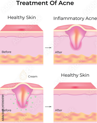 Acne Treatment Process From Inflammatory Acne to Healthy Skin Vector Illustration