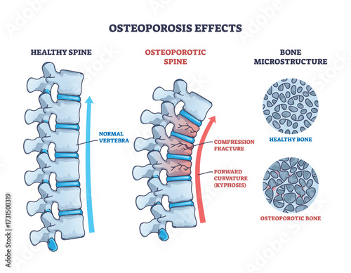 Osteoporosis diagram shows healthy vs osteoporotic spine and bone microstructure, highlighting vertebrae, fractures, and bone density loss. Outline diagram